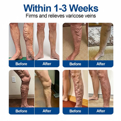 🇺🇸👨‍⚕️✅ Medistart®  VeinRepair Microneedle Care Patch⚡Instant Relief, Long-Term Results