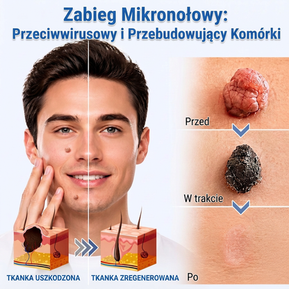 ✨PuraCure® 2-w-1 plaster mikroigłowy i hydrokoloidowy🍀 | Usuwa wypukłe znamiona, trądzik, płaskie brodawki i brodawki skórne | Pomaga poprawić zmarszczki, blizny i niedoskonałości | Niewidoczne plastry na twarz i ciało