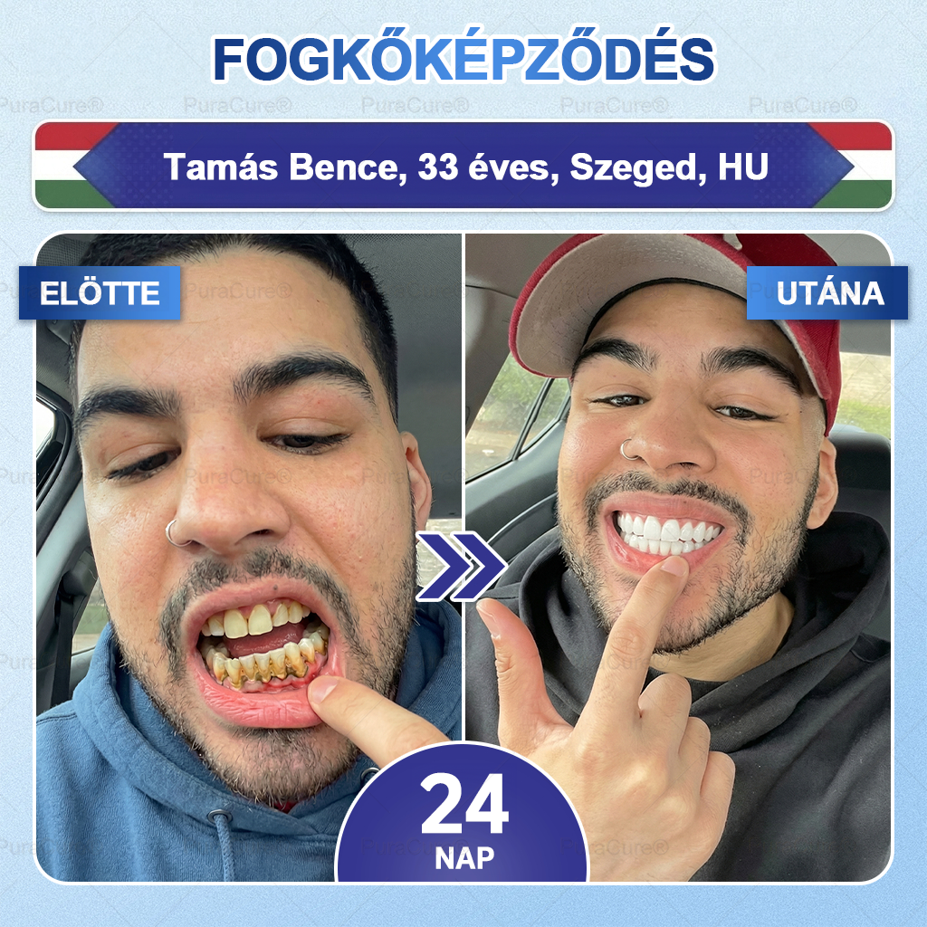 🦷PuraCure® többhatású fog- és ínyregeneráló szájvíz | Kollagén × posztbiotikumok × β-glükanáz