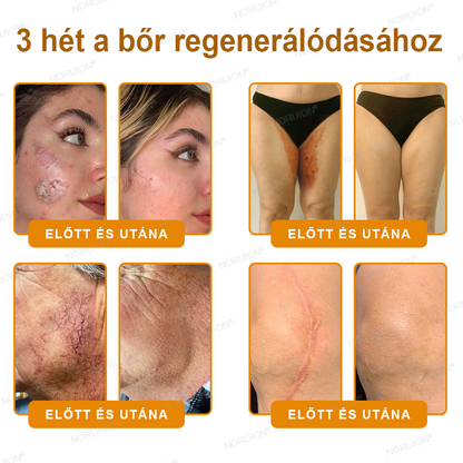 ✨FDA által jóváhagyva: 𝐍𝐎𝐑𝐔𝐈𝐎𝐍® 𝐌é𝐡𝐦é𝐫𝐞𝐠 𝐁ő𝐫𝐦𝐞𝐠ú𝐣í𝐭ó 𝐊𝐫é𝐦 — 🔥𝐊𝐨𝐫𝐥á𝐭𝐨𝐳𝐨𝐭𝐭 𝐢𝐝𝐞𝐢𝐠 𝟕𝟎% 𝐤𝐞𝐝𝐯𝐞𝐳𝐦é𝐧𝐲🔥