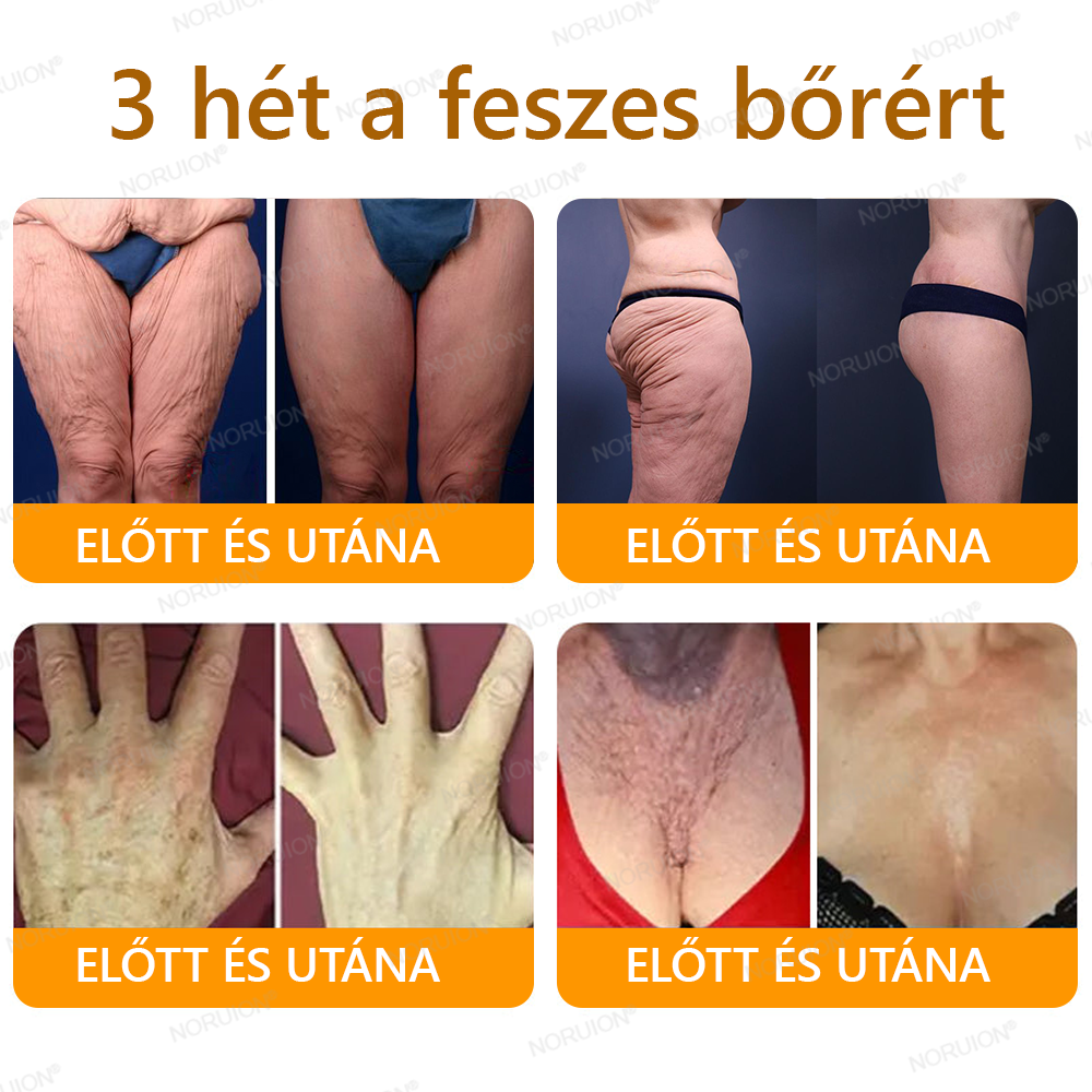 ✨FDA által jóváhagyva: 𝐍𝐎𝐑𝐔𝐈𝐎𝐍® 𝐌é𝐡𝐦é𝐫𝐞𝐠 𝐁ő𝐫𝐦𝐞𝐠ú𝐣í𝐭ó 𝐊𝐫é𝐦 — 🔥𝐊𝐨𝐫𝐥á𝐭𝐨𝐳𝐨𝐭𝐭 𝐢𝐝𝐞𝐢𝐠 𝟕𝟎% 𝐤𝐞𝐝𝐯𝐞𝐳𝐦é𝐧𝐲🔥