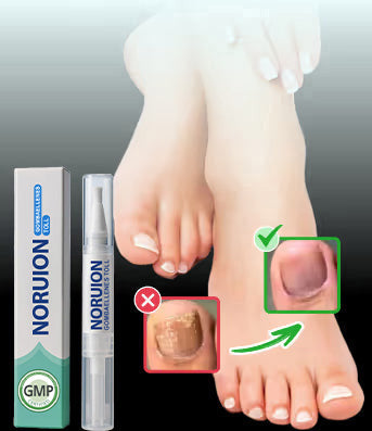 Természetes megoldás a körömgomba végleges eltávolítására ✨ Nincs szégyen, nincs vegyszer. Látható javulás*🔥