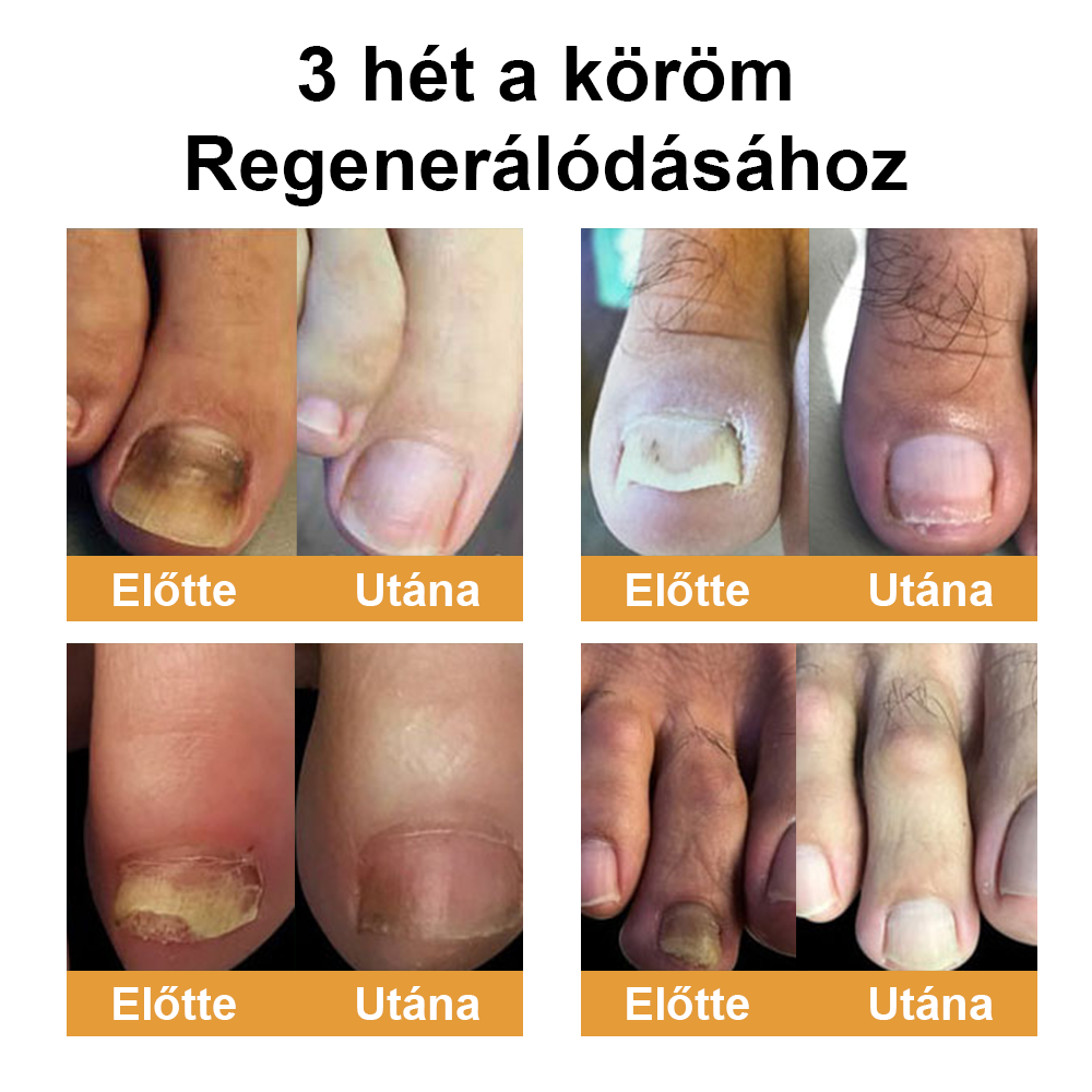 Természetes megoldás a körömgomba végleges eltávolítására ✨ Nincs szégyen, nincs vegyszer. Látható javulás*🔥
