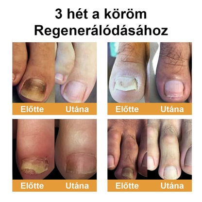 Természetes megoldás a körömgomba végleges eltávolítására ✨ Nincs szégyen, nincs vegyszer. Látható javulás*🔥