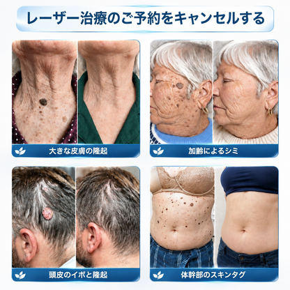 PuraCure®👩‍⚕️ 7日間で実感 イボ・気になる肌悩み用 消すローラーペン｜痛みなし・跡が残りにくい