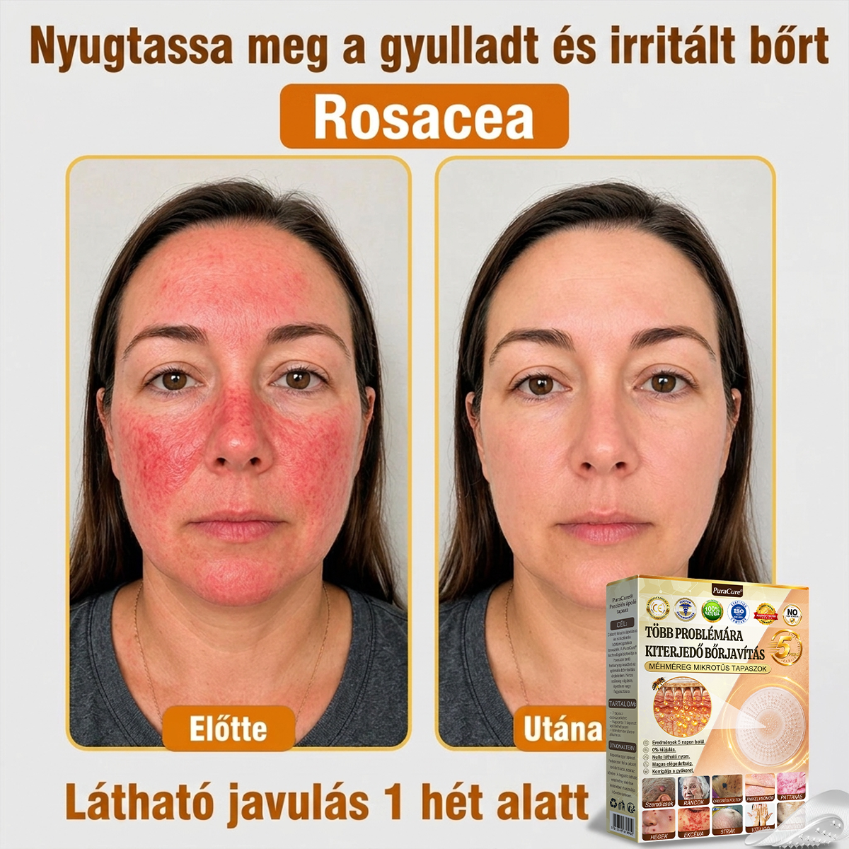 ✨PuraCure® TÖBBFÉLE BŐRPROBLÉMÁRA HATÓ MÉHMÉREG MIKROTŰS BŐRREGENERÁLÓ TAPASZOK