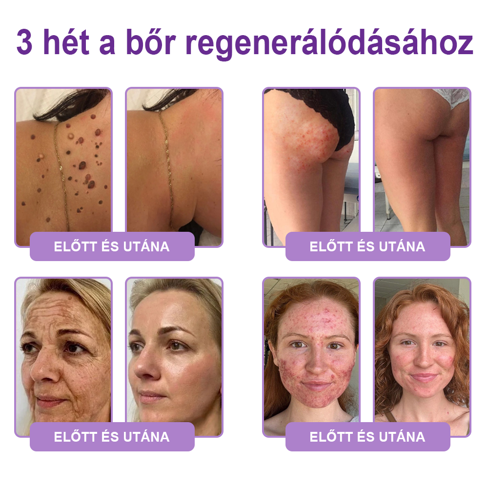PuraCure® PDRN Multi-Peptid Masszírozó Testgörgős Krém – Öregedésgátlás, hidratálás, bőrfeszesítő és emelő hatás bőrjavítás, egyenletes bőrtónus, akne sötét foltok kezelése, szemölcsök és anyajegyek eltávolítása, valamint pikkelysömör enyhítése.