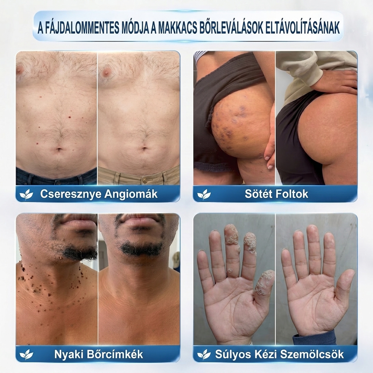 𝐏𝐮𝐫𝐚𝐂𝐮𝐫𝐞® 𝐌𝐈𝐊𝐑𝐎𝐓Ű𝐒 𝐁Ő𝐑𝐊𝐈𝐍Ö𝐕É𝐒-𝐄𝐋𝐓Á𝐕𝐎𝐋Í𝐓Ó 𝐓𝐀𝐏𝐀𝐒𝐙𝐎𝐊 —𝟕 𝐍𝐀𝐏𝐎𝐒 𝐂É𝐋𝐙𝐎𝐓𝐓 𝐄𝐋𝐓Á𝐕𝐎𝐋Í𝐓Á𝐒 𝐁Ő𝐑𝐍𝐘Ú𝐋𝐕Á𝐍𝐘𝐎𝐊, 𝐒𝐙𝐄𝐌Ö𝐋𝐂𝐒Ö𝐊 É𝐒 𝐊𝐈𝐄𝐌𝐄𝐋𝐊𝐄𝐃Ő 𝐁Ő𝐑𝐇𝐈𝐁Á𝐊 𝐄𝐋𝐋𝐄𝐍
