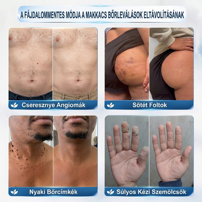 𝐏𝐮𝐫𝐚𝐂𝐮𝐫𝐞® 𝐌𝐈𝐊𝐑𝐎𝐓Ű𝐒 𝐁Ő𝐑𝐊𝐈𝐍Ö𝐕É𝐒-𝐄𝐋𝐓Á𝐕𝐎𝐋Í𝐓Ó 𝐓𝐀𝐏𝐀𝐒𝐙𝐎𝐊 —𝟕 𝐍𝐀𝐏𝐎𝐒 𝐂É𝐋𝐙𝐎𝐓𝐓 𝐄𝐋𝐓Á𝐕𝐎𝐋Í𝐓Á𝐒 𝐁Ő𝐑𝐍𝐘Ú𝐋𝐕Á𝐍𝐘𝐎𝐊, 𝐒𝐙𝐄𝐌Ö𝐋𝐂𝐒Ö𝐊 É𝐒 𝐊𝐈𝐄𝐌𝐄𝐋𝐊𝐄𝐃Ő 𝐁Ő𝐑𝐇𝐈𝐁Á𝐊 𝐄𝐋𝐋𝐄𝐍