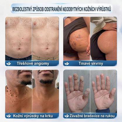 PuraCure® MIKROJEHLIČKOVÉ NÁPLASTI PRO ODSTRANĚNÍ KOŽNÍCH VÝRŮSTKŮ —— 7DENNÍ CÍLENÁ PÉČE PRO KOŽNÍ VÝRŮSTKY, BRADAVICE A VYSTOUPLÉ NEDOKONALOSTI POKOŽKY