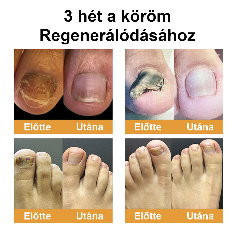 Természetes megoldás a körömgomba végleges eltávolítására ✨ Nincs szégyen, nincs vegyszer. Látható javulás*🔥