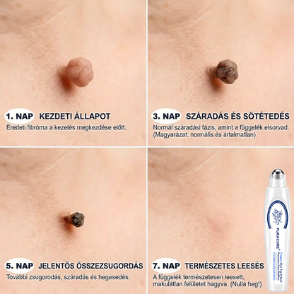 PuraCure® 👩‍⚕️ 7 Napos Bőrkinövés- és Anyajegyápoló Roller – Fájdalommentes, Hegmentes Bőrhibák Ellen