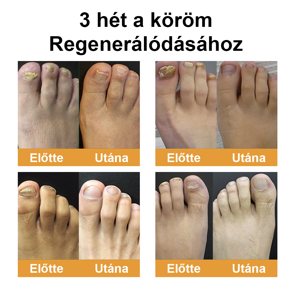 Természetes megoldás a körömgomba végleges eltávolítására ✨ Nincs szégyen, nincs vegyszer. Látható javulás*🔥