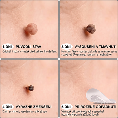 PuraCure® MIKROJEHLIČKOVÉ NÁPLASTI PRO ODSTRANĚNÍ KOŽNÍCH VÝRŮSTKŮ —— 7DENNÍ CÍLENÁ PÉČE PRO KOŽNÍ VÝRŮSTKY, BRADAVICE A VYSTOUPLÉ NEDOKONALOSTI POKOŽKY