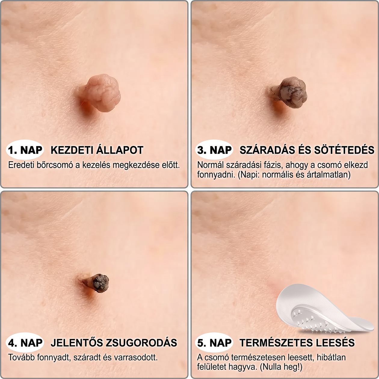 𝐏𝐮𝐫𝐚𝐂𝐮𝐫𝐞® 𝐌𝐈𝐊𝐑𝐎𝐓Ű𝐒 𝐁Ő𝐑𝐊𝐈𝐍Ö𝐕É𝐒-𝐄𝐋𝐓Á𝐕𝐎𝐋Í𝐓Ó 𝐓𝐀𝐏𝐀𝐒𝐙𝐎𝐊 —𝟕 𝐍𝐀𝐏𝐎𝐒 𝐂É𝐋𝐙𝐎𝐓𝐓 𝐄𝐋𝐓Á𝐕𝐎𝐋Í𝐓Á𝐒 𝐁Ő𝐑𝐍𝐘Ú𝐋𝐕Á𝐍𝐘𝐎𝐊, 𝐒𝐙𝐄𝐌Ö𝐋𝐂𝐒Ö𝐊 É𝐒 𝐊𝐈𝐄𝐌𝐄𝐋𝐊𝐄𝐃Ő 𝐁Ő𝐑𝐇𝐈𝐁Á𝐊 𝐄𝐋𝐋𝐄𝐍