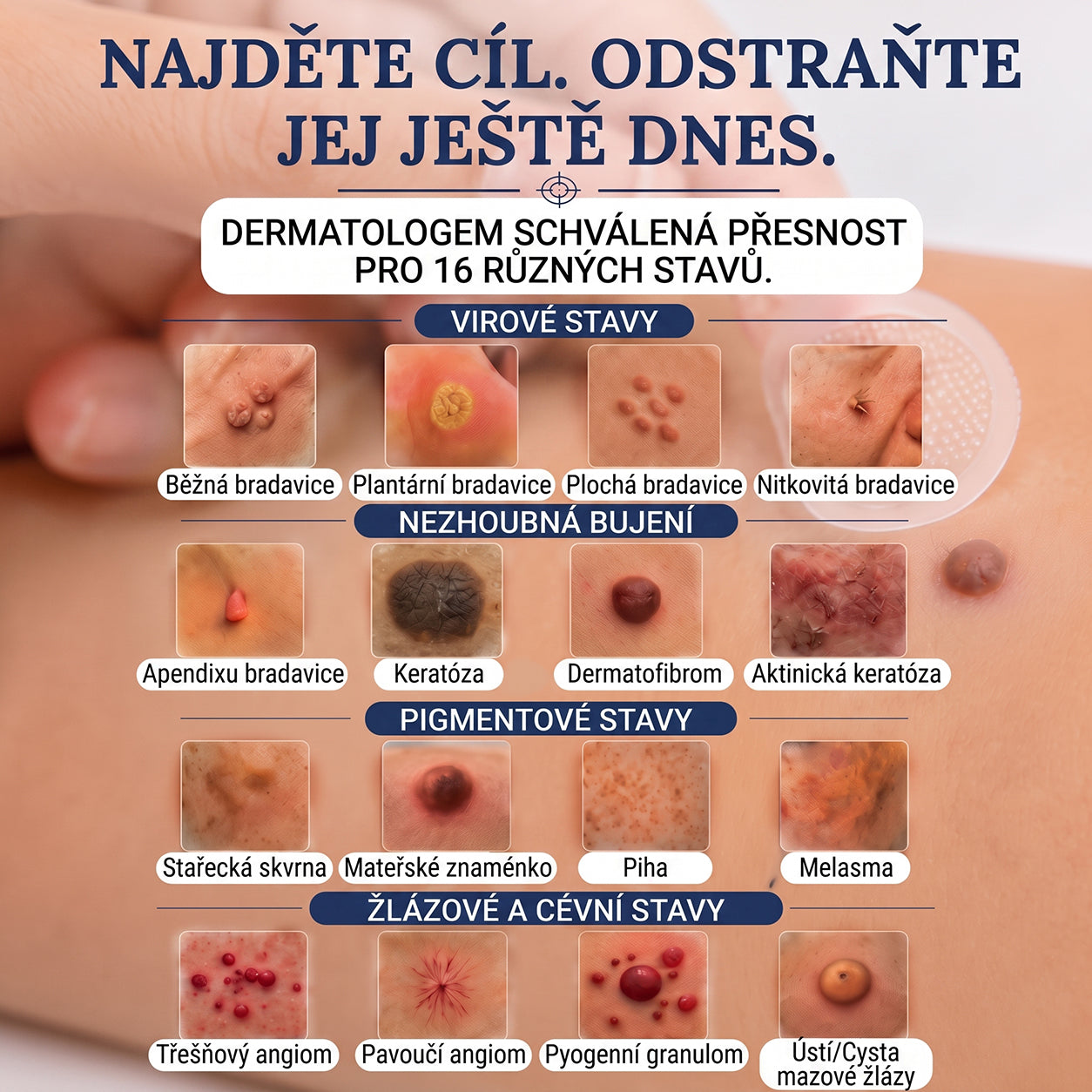 PuraCure® MIKROJEHLIČKOVÉ NÁPLASTI PRO ODSTRANĚNÍ KOŽNÍCH VÝRŮSTKŮ —— 7DENNÍ CÍLENÁ PÉČE PRO KOŽNÍ VÝRŮSTKY, BRADAVICE A VYSTOUPLÉ NEDOKONALOSTI POKOŽKY