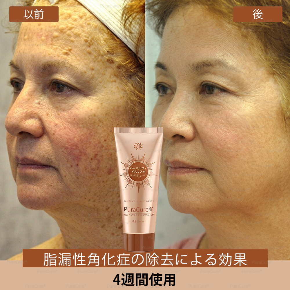 🏵️PuraCure® 美白・スポットケアフェイスマスク【顔・ボディ兼用】天然由来成分配合で、シミ・そばかす・日焼けによるシミを長期間ケア✨