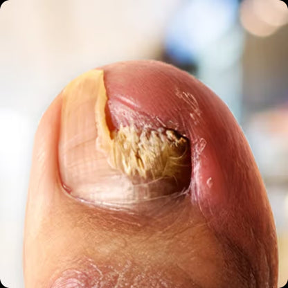 Természetes megoldás a körömgomba végleges eltávolítására ✨ Nincs szégyen, nincs vegyszer. Látható javulás*🔥