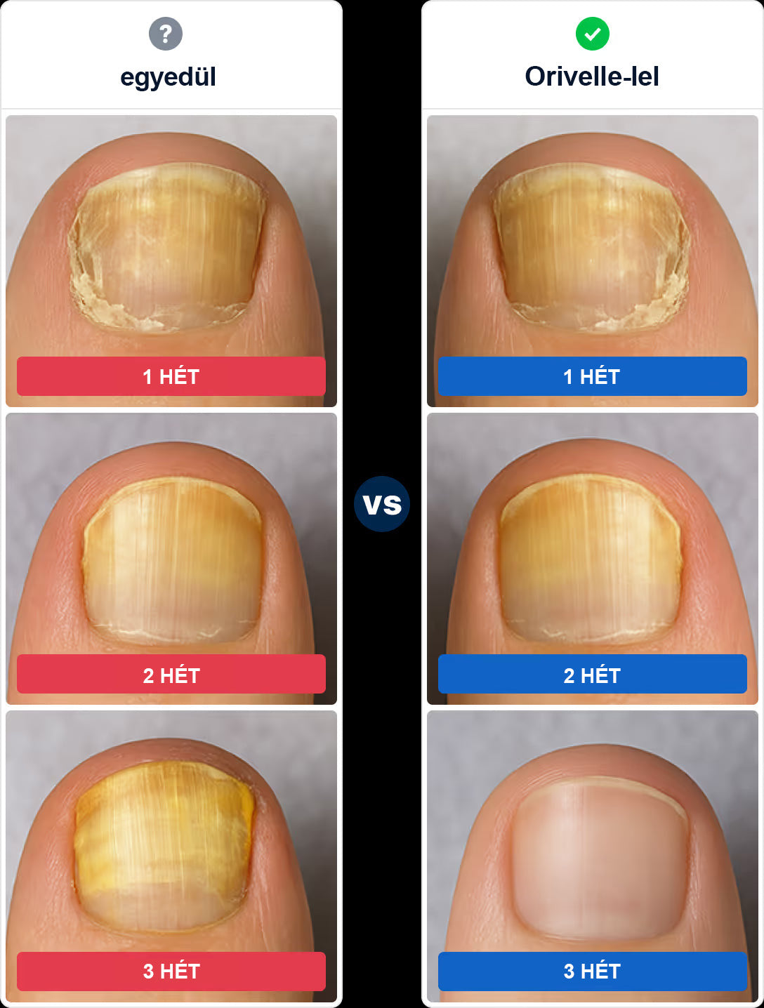 Természetes megoldás a körömgomba végleges eltávolítására ✨ Nincs szégyen, nincs vegyszer. Látható javulás*🔥