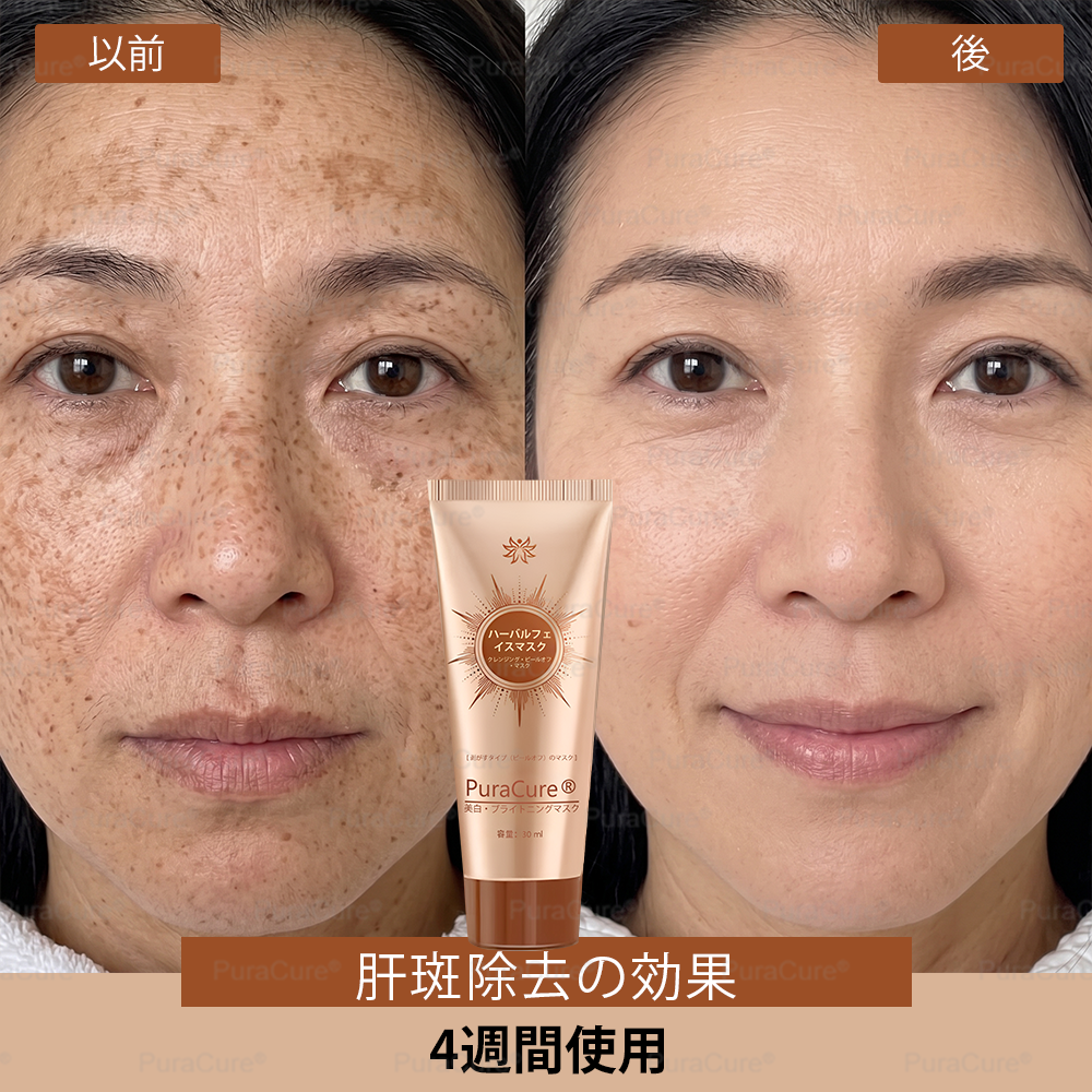 🏵️PuraCure® 美白・スポットケアフェイスマスク【顔・ボディ兼用】天然由来成分配合で、シミ・そばかす・日焼けによるシミを長期間ケア✨