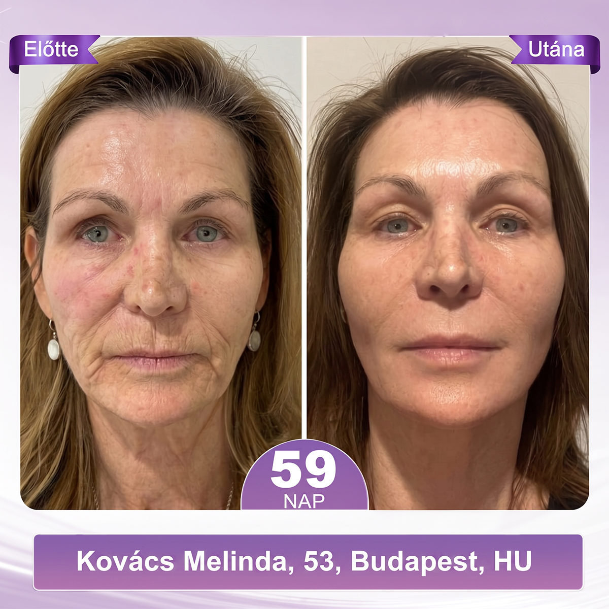 PuraCure® PDRN Multi-Peptid Masszírozó Testgörgős Krém – Öregedésgátlás, hidratálás, bőrfeszesítő és emelő hatás bőrjavítás, egyenletes bőrtónus, akne sötét foltok kezelése, szemölcsök és anyajegyek eltávolítása, valamint pikkelysömör enyhítése.