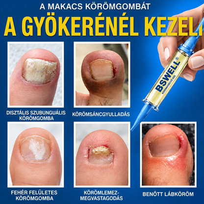 🩹🇭🇺 BSWELL® Gomba‑mentes méhméreg körömkezelés 💅🦶