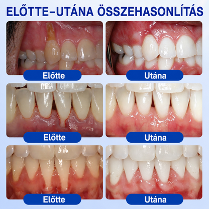 🇭🇺👨‍⚕️✅🦷 PuraCure® ÍNYMEGÚJÍTÓ – Parodontális helyreállító gél🧂