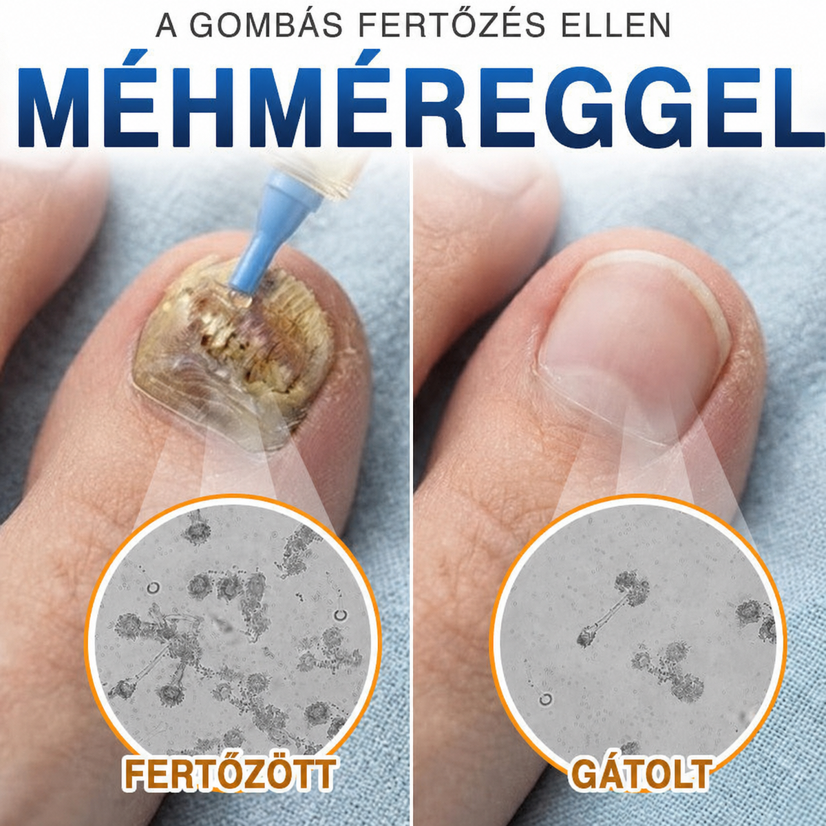 🩹🇭🇺 BSWELL® Gomba‑mentes méhméreg körömkezelés 💅🦶